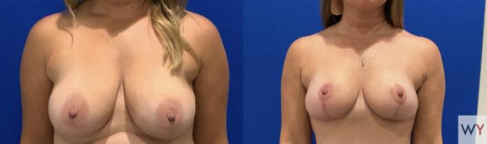 Before & After Mommy Makeover Case 143 Front Breast View in Sacramento, Granite Bay, & Roseville, CA