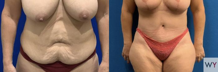 Before & After Mommy Makeover Case 144 Front Abdomen View in Sacramento, Granite Bay, & Roseville, CA