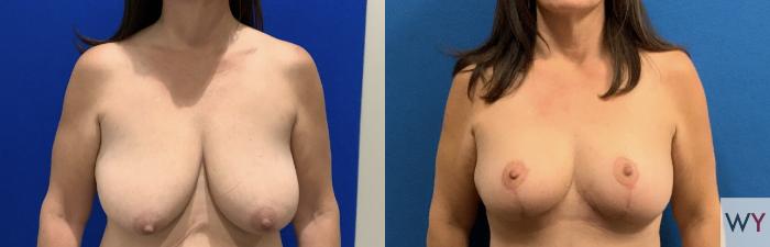 Before & After Mommy Makeover Case 144 Front Breast View in Sacramento, Granite Bay, & Roseville, CA