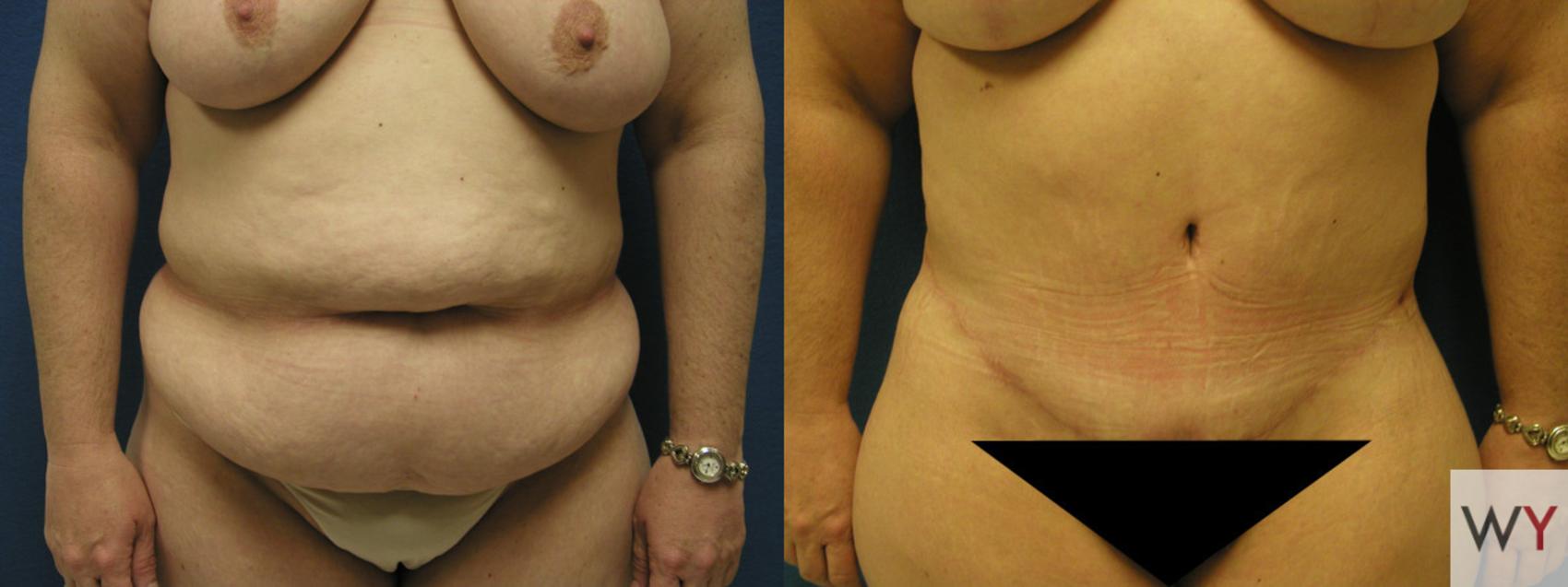 Before & After Tummy Tuck Case 71 View #2 View in Sacramento, CA