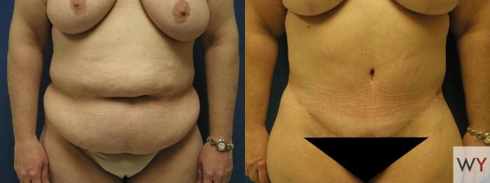 Before & After Tummy Tuck Case 71 View #2 View in Sacramento, Granite Bay, & Roseville, CA