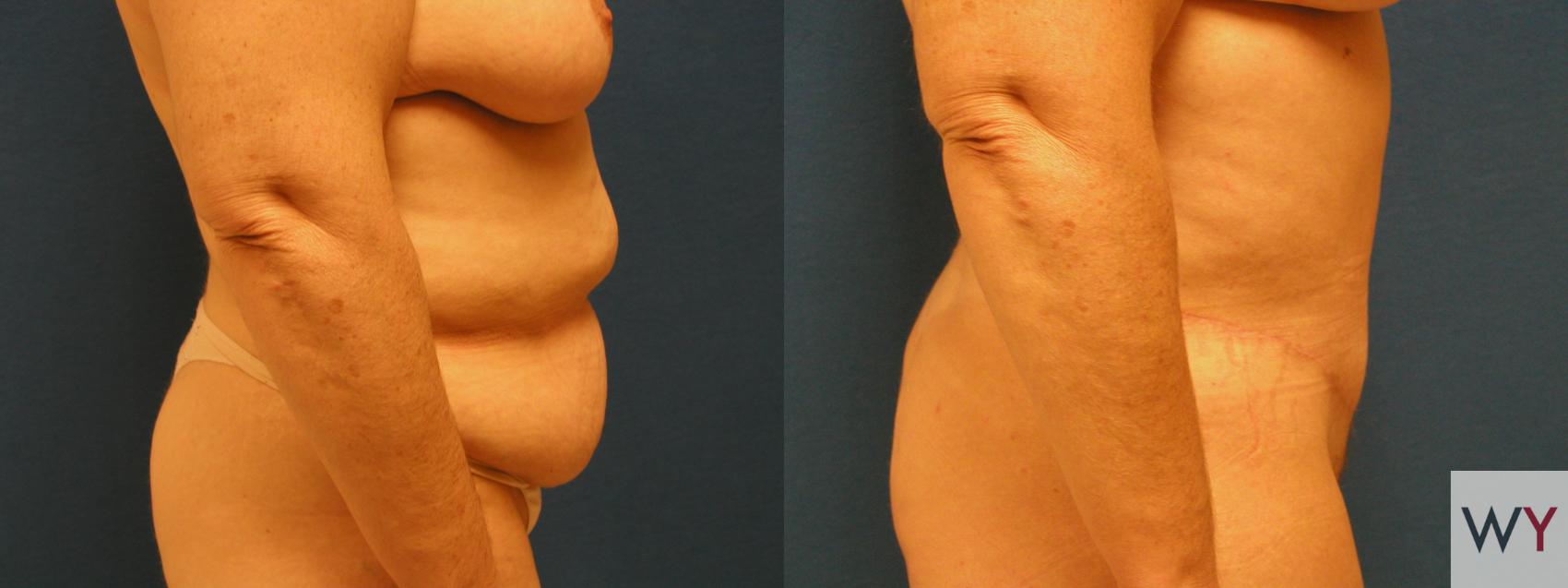 Before & After Tummy Tuck Case 71 View #3 View in Sacramento, CA