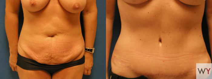 Before & After Tummy Tuck Case 72 View #1 View in Sacramento, Granite Bay, & Roseville, CA