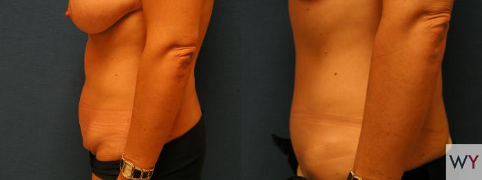 Before & After Tummy Tuck Case 72 View #2 View in Sacramento, Granite Bay, & Roseville, CA