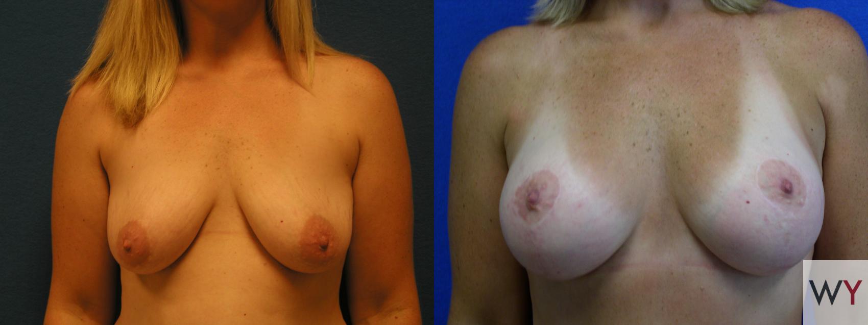 Before & After Breast Lift Case 76 View #2 View in Sacramento, CA