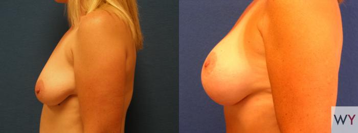 Before & After Breast Lift Case 76 View #5 View in Sacramento, Granite Bay, & Roseville, CA