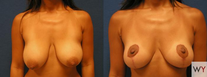 Before & After Breast Lift Case 77 View #1 View in Sacramento, Granite Bay, & Roseville, CA