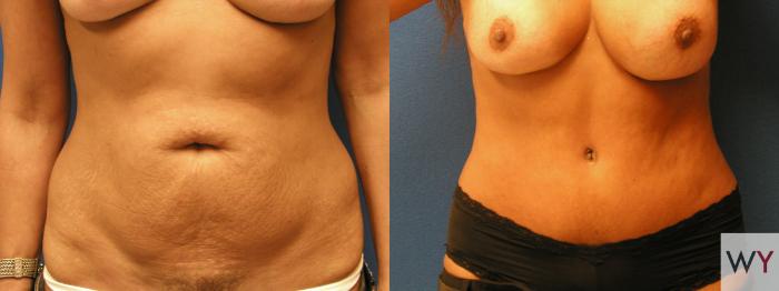 Before & After Tummy Tuck Case 102 View #1 View in Sacramento, Granite Bay, & Roseville, CA