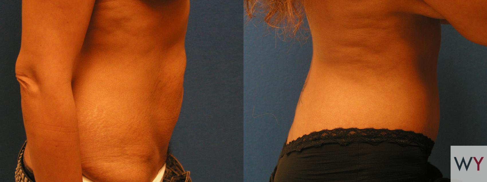 Before & After Tummy Tuck Case 102 View #2 View in Sacramento, CA