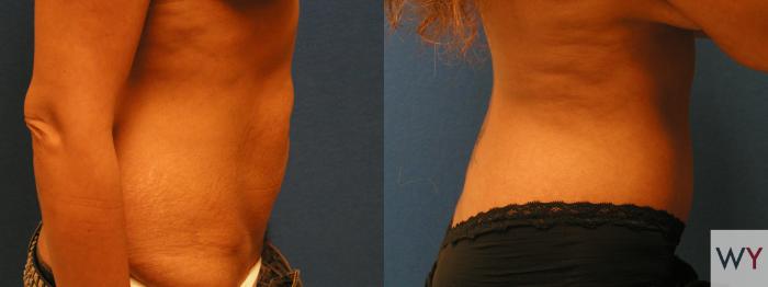 Before & After Tummy Tuck Case 102 View #2 View in Sacramento, Granite Bay, & Roseville, CA