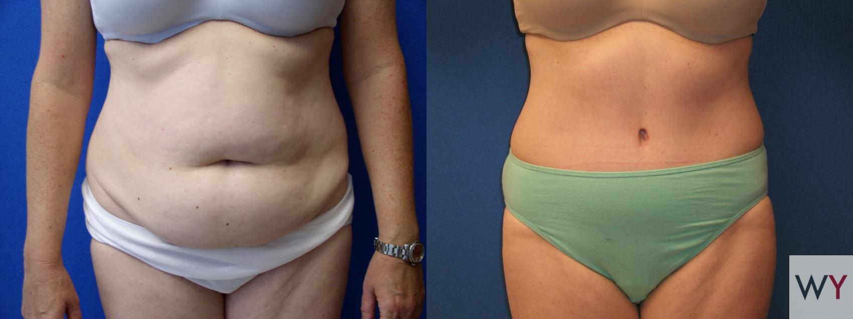 Before & After Tummy Tuck Case 105 View #1 View in Sacramento, CA
