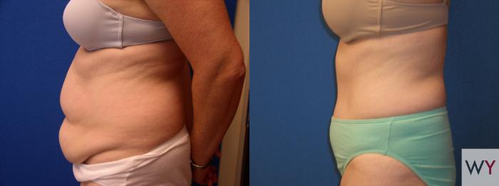 Before & After Tummy Tuck Case 105 View #2 View in Sacramento, Granite Bay, & Roseville, CA