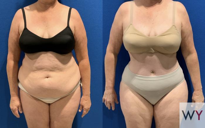 Before Tummy Tuck with Liposuction