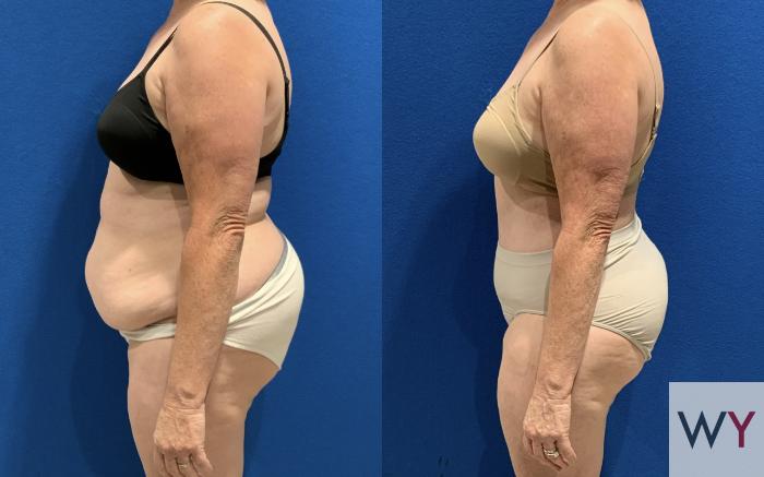 Before Tummy Tuck with Liposuction