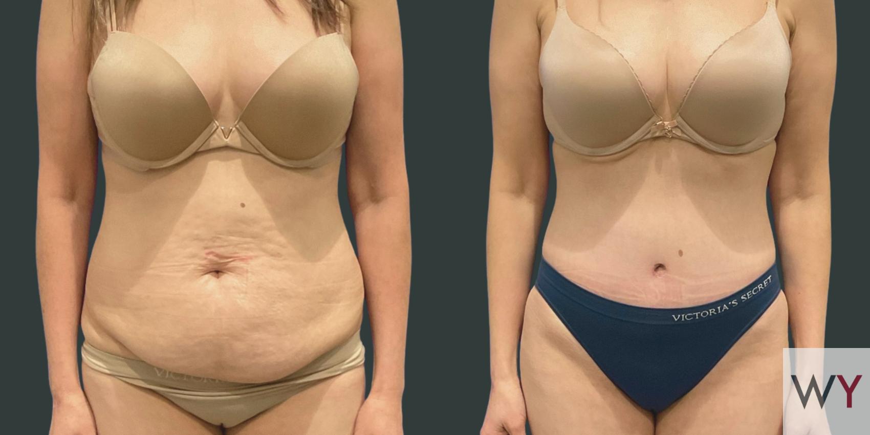 Extended Tummy Tuck Patient Results