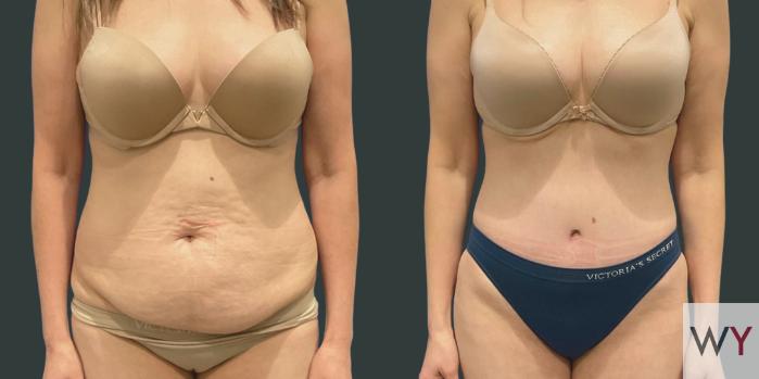 Extended Tummy Tuck Patient Results