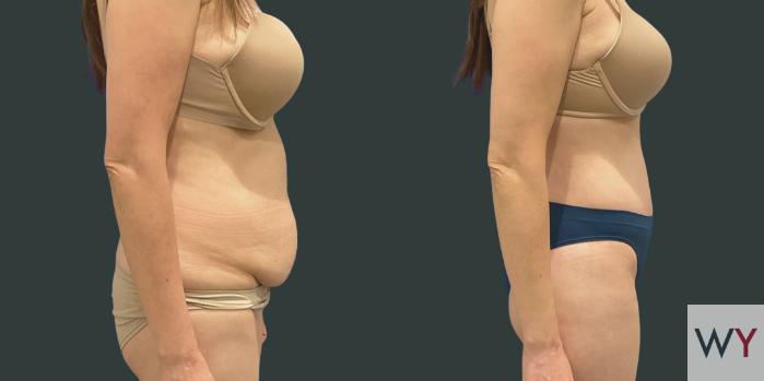 Right Side of Tummy Tuck Patient