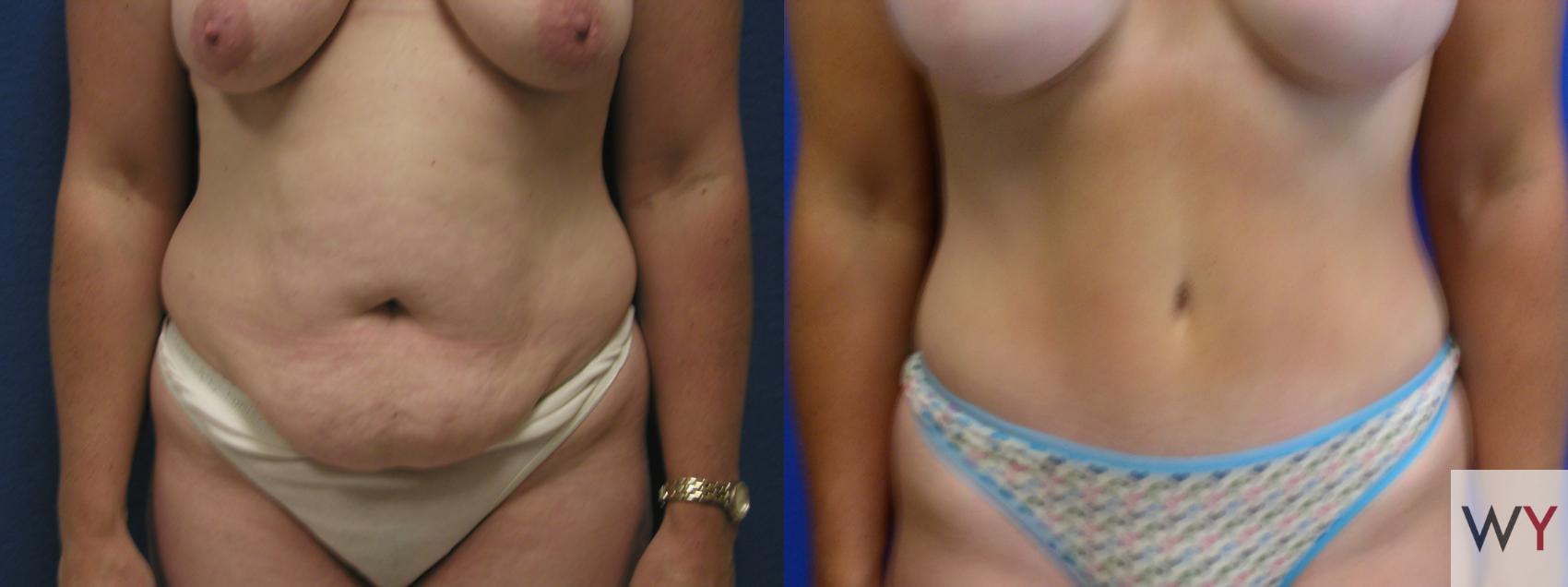 Tummy Tuck Before and After Pictures Case 806, Shreveport, LA