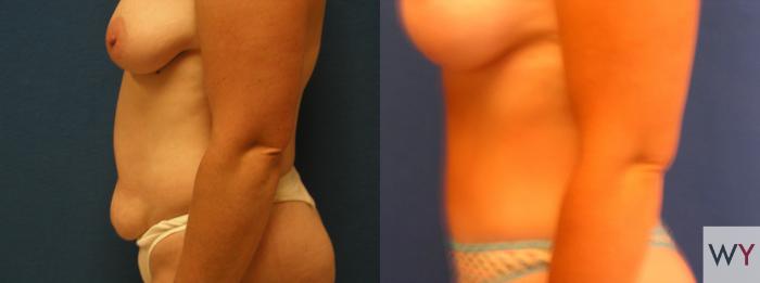 Before & After Tummy Tuck Case 68 View #2 View in Sacramento, Granite Bay, & Roseville, CA