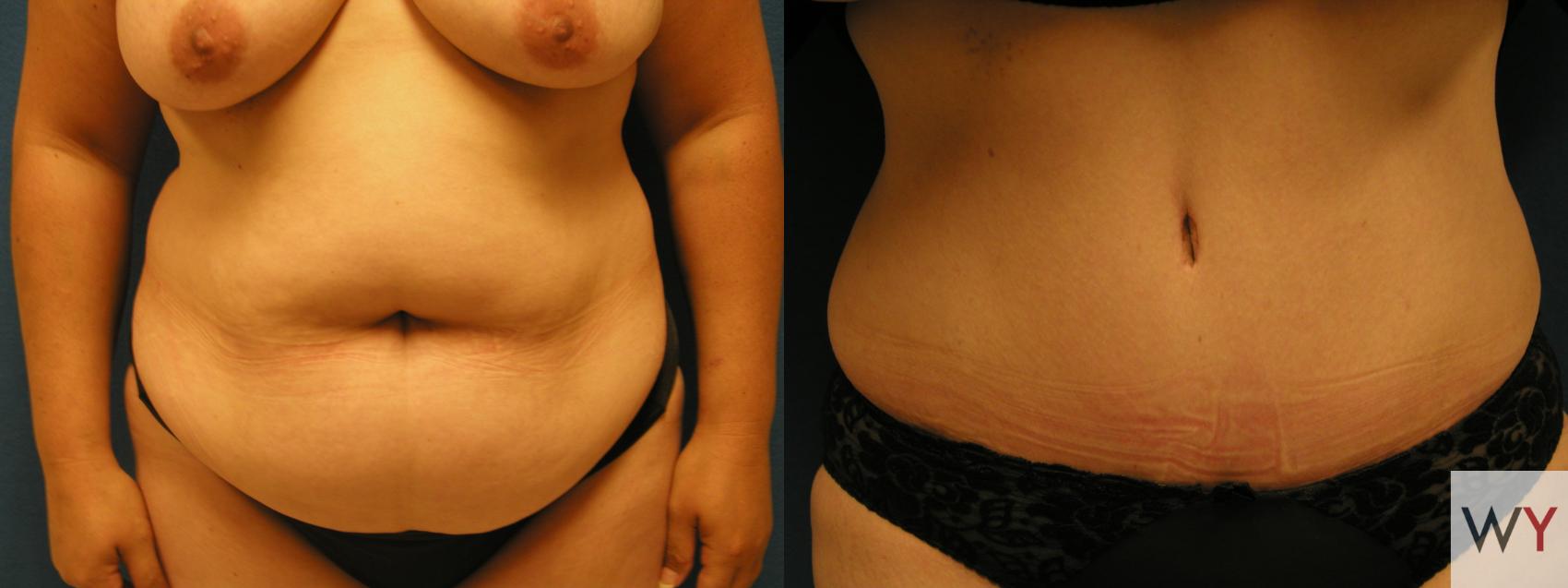 Before & After Tummy Tuck Case 69 View #1 View in Sacramento, Granite Bay, & Roseville, CA