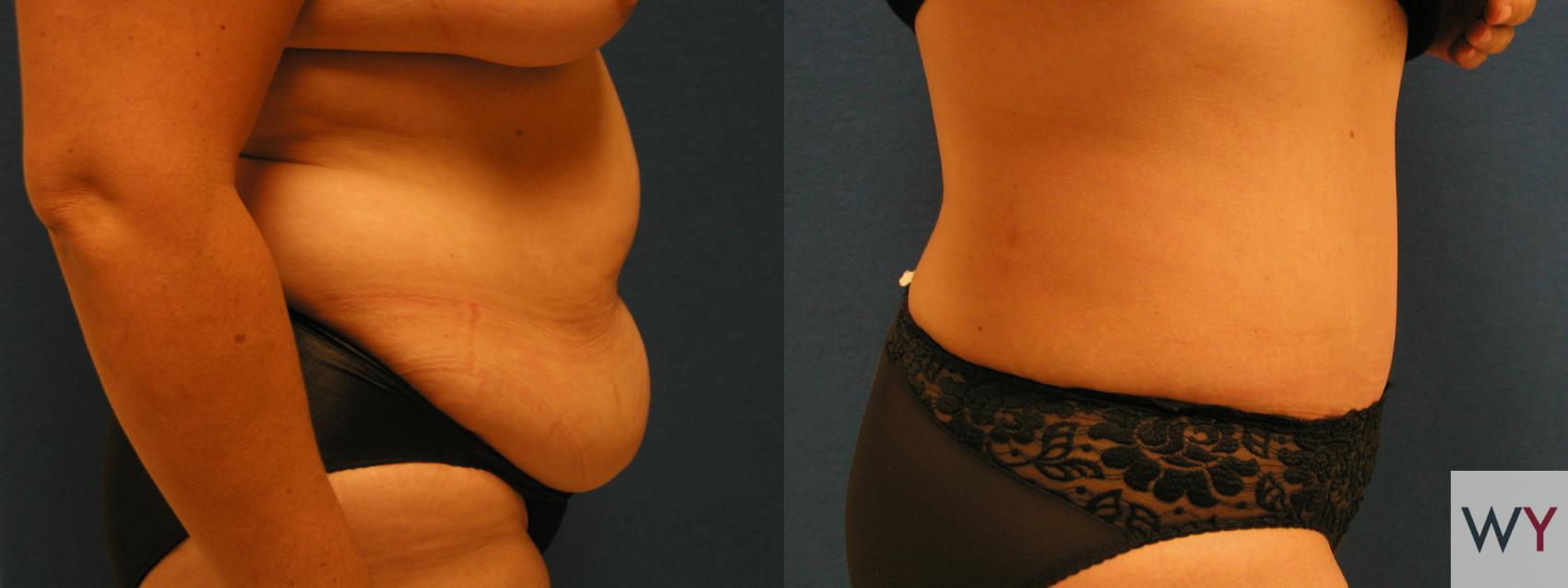 Before & After Tummy Tuck Case 69 View #2 View in Sacramento, CA