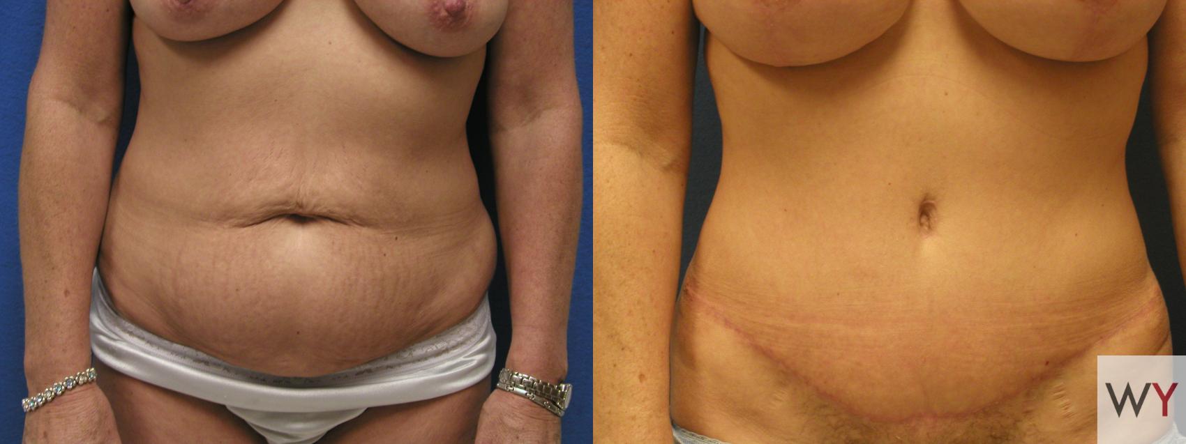 Before & After Tummy Tuck Case 70 View #1 View in Sacramento, Granite Bay, & Roseville, CA