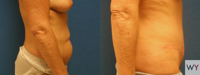 Before & After Tummy Tuck Case 70 View #2 View in Sacramento, Granite Bay, & Roseville, CA