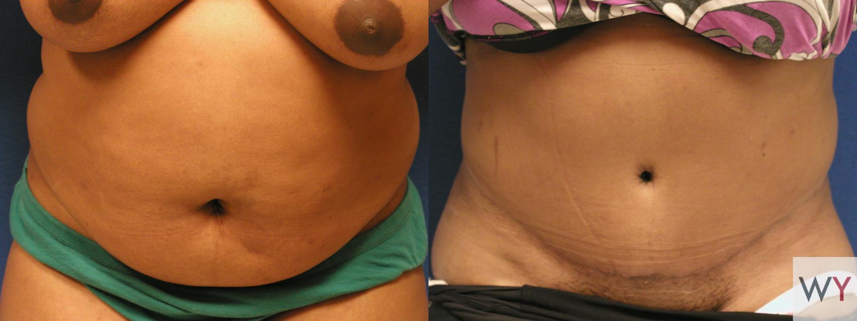 Before & After Tummy Tuck Case 73 View #1 View in Sacramento, CA