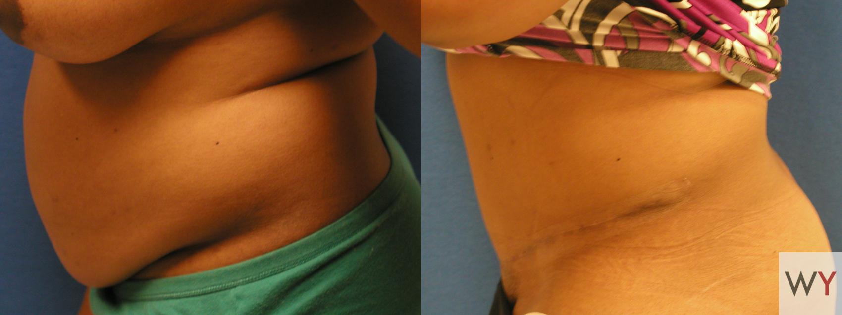 Before & After Tummy Tuck Case 73 View #2 View in Sacramento, CA