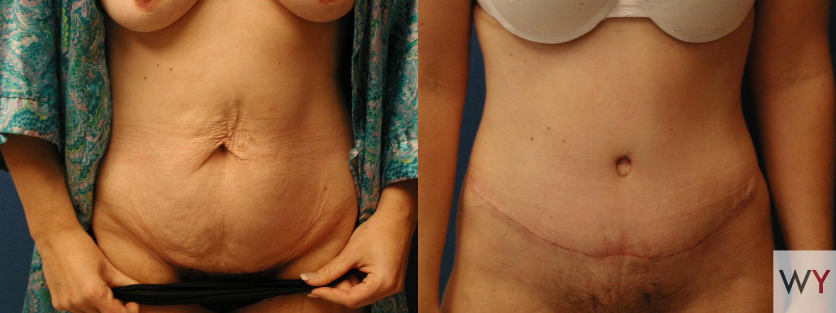 Before & After Tummy Tuck Case 74 View #1 View in Sacramento, Granite Bay, & Roseville, CA