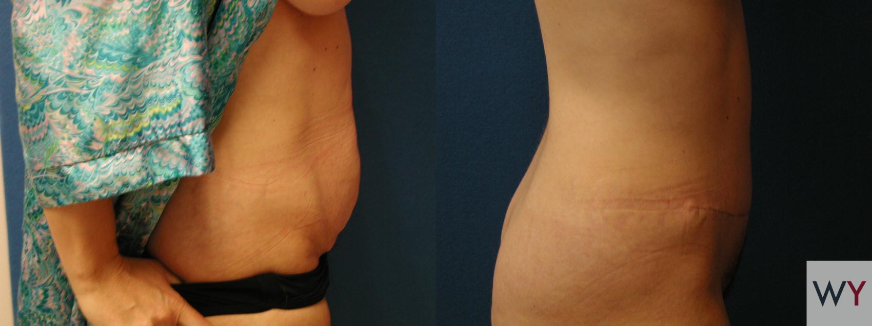 Before & After Tummy Tuck Case 74 View #2 View in Sacramento, CA