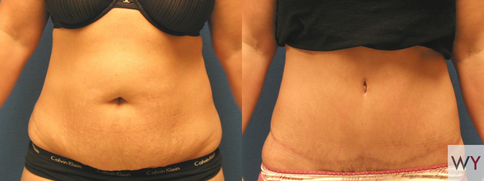 Before & After Tummy Tuck Case 97 View #1 View in Sacramento, Granite Bay, & Roseville, CA