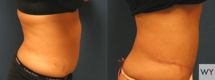 Before & After Tummy Tuck Case 97 View #2 View in Sacramento, Granite Bay, & Roseville, CA