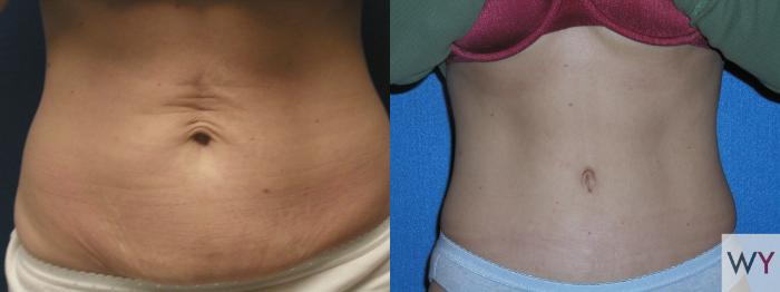 Before & After Tummy Tuck Case 98 View #1 View in Sacramento, Granite Bay, & Roseville, CA