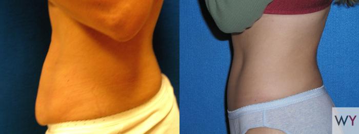 Before & After Tummy Tuck Case 98 View #2 View in Sacramento, Granite Bay, & Roseville, CA