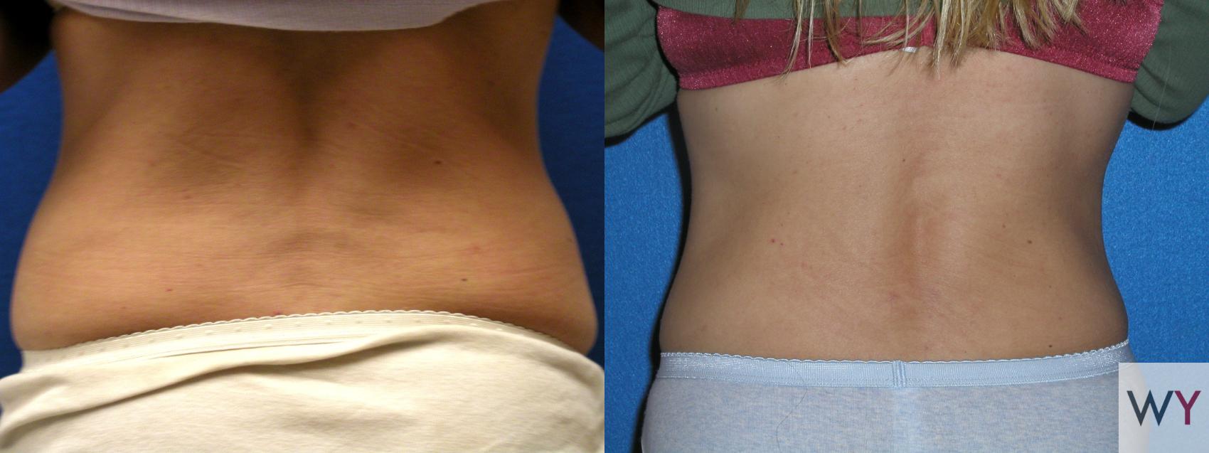 Before & After Tummy Tuck Case 98 View #3 View in Sacramento, CA