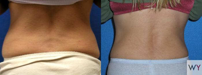 Before & After Tummy Tuck Case 98 View #3 View in Sacramento, Granite Bay, & Roseville, CA